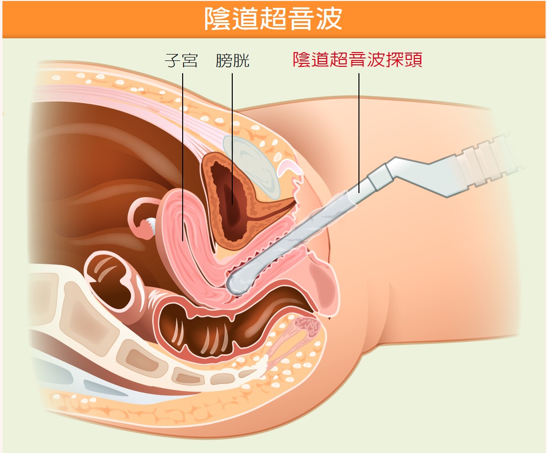 陰道 內 視